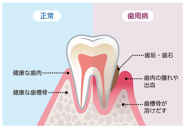 正常な時と歯周病の時の歯の比較イメージ